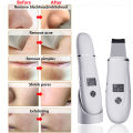 Facial With Blackhead Removal|vanity Planet Ultrasonic Skin Scrubber - Ems Facial Cleansing, Blackhead Removal. 