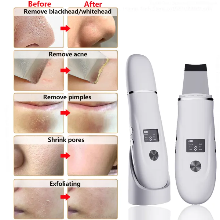Facial%20With%20Blackhead%20Removal%7Cvanity%20Planet%20Ultrasonic%20Skin%20Scrubber%20-%20Ems%20Facial%20Cleansing,%20Blackhead%20Removal%20-%20Image%207