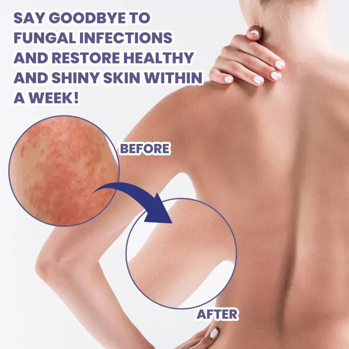Eczema%20Treatment%20Cream%20Dermatitis%20Anti%20Itching%20Inhibit%20Fungi%20Urticaria%20Infection%20Prevent%20Hand%20Tinea%20Allergy%20Rash%20Repair%20Ointment%20-%20Image%205