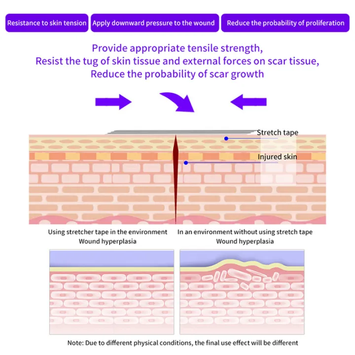 Stitch%20Free%20Adhesive%20Tape%20For%20Medical%20Wound%20Closure%20Strips%20Surgical%20Sutures%20Postpartum%20Wound%20Repair%20Cosmetic%20Adhesive%20Medical%20ZHIXING%20-%20Image%206