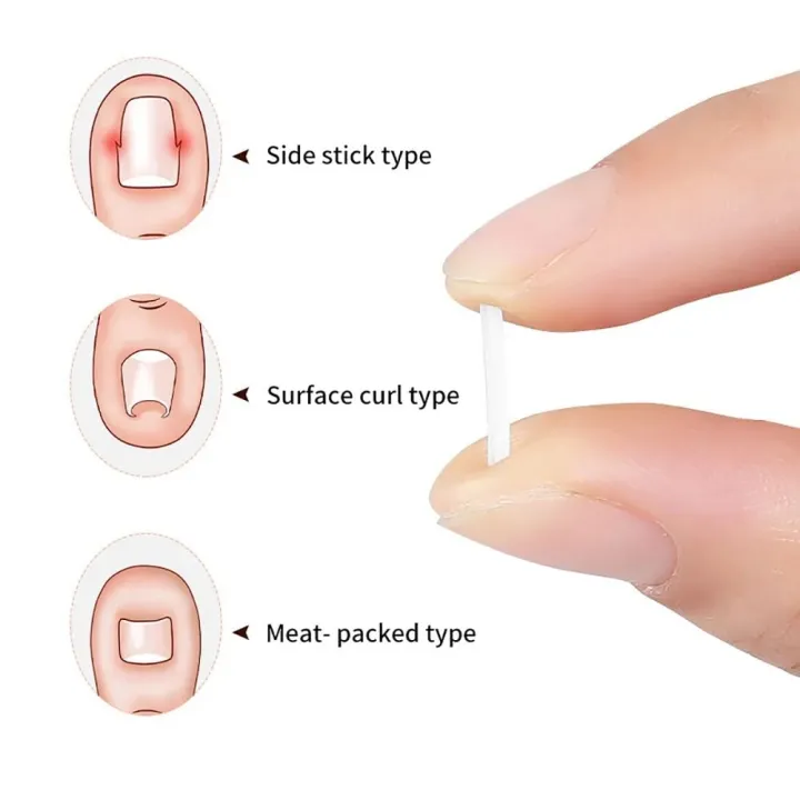 50Pcs/box%20New%20Brace%20Pedicure%20Tool%20Ingrown%20Toenail%20Correction%20Tool%20Filling%20Pad%20Nail%20Picker%20Elastic%20Patch%20Sticker%20Plastic%20Ingrown%20Toe%20Nail%20Treatment%20Straightening%20Clip%20-%20Image%207