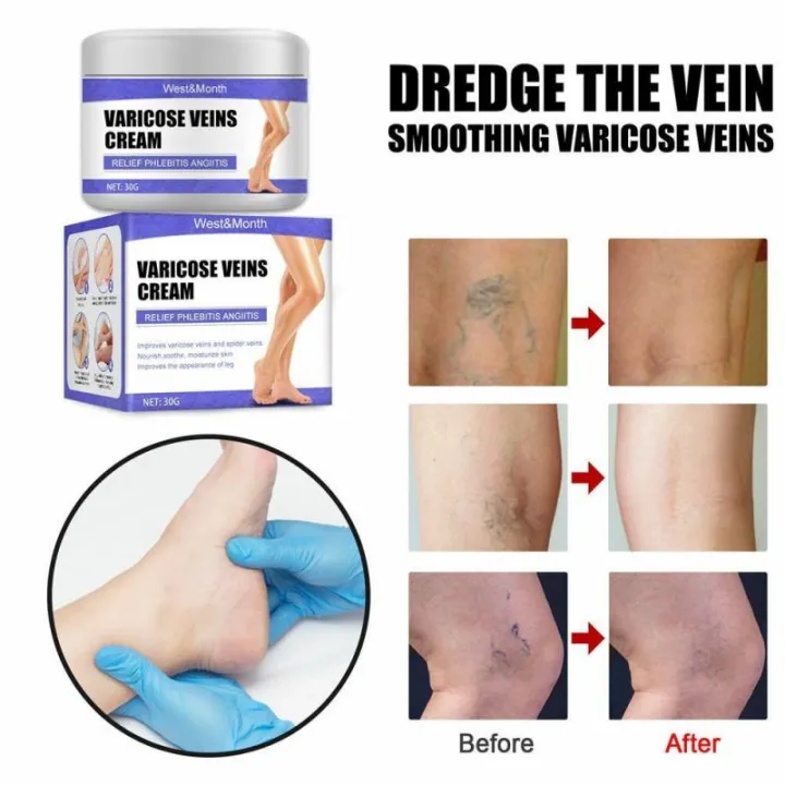 Varicose%20Vein%20Treatments%20Cream%20Effective%20Relieve%20Legs%20Dilated%20Vasculitis%20Phlebitis%20Natural%20Formula%20Ointment%20For%20Varicose%20Veins%20-%20Image%204