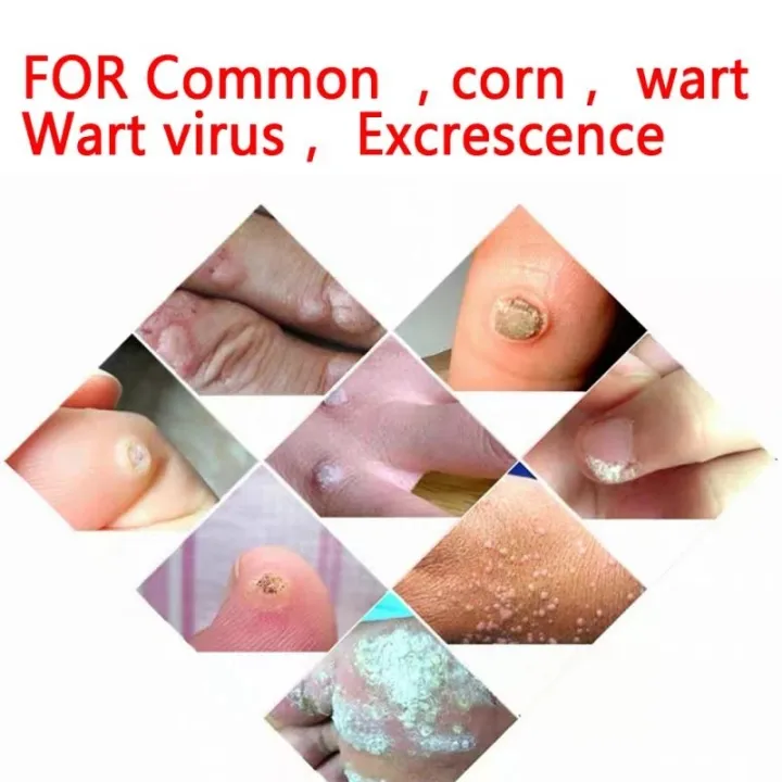 warts%20removal%20Corn%20Plaster%20for%2014%20days%20easy%20wart%20removal%20without%20any%20pain%20-%207%20pack%20-%20Image%202