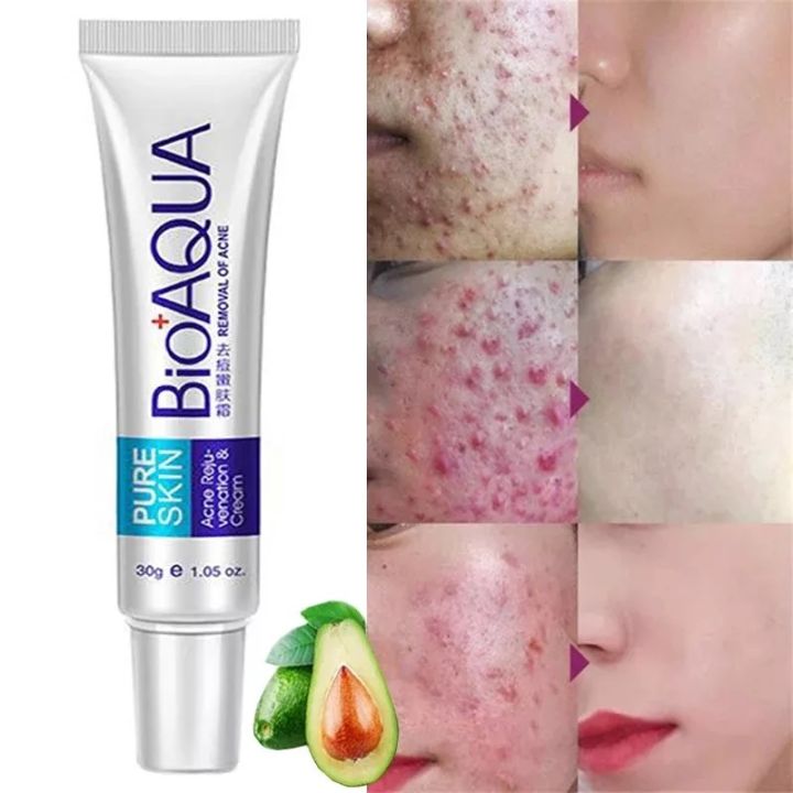 Bioaqua Pure Skin Face Care Acne Treatment Scar Removal Cream Stretch Marks Pimples Blackheads