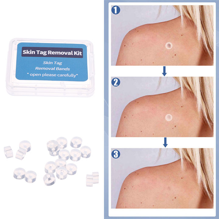 20pcs Skin Tag Removal Rubber Bands Micro Band Non Toxic Face Care Mole Wart Skin Care Tools