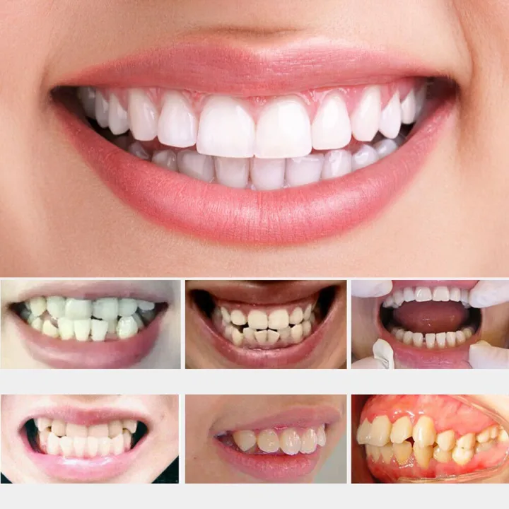 3 Stages Silicone Tooth Invisible Orthodontic Set Dental Appliance Teeth Retainer Mouth Guard Braces Tooth Tray Tooth Care Tool
