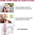 Portable Travel Adults Children 2 Size Choking Rescue Vac Device CPR First Aid Kit Life Choking Device Anti Suffocation Saver. 