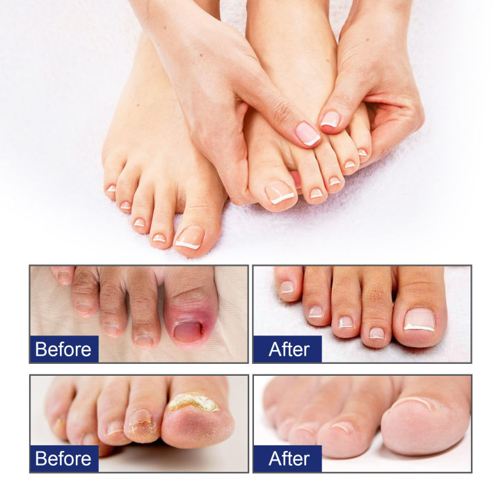 Ingrown%20Toenail%20Treatment%20Serum%20Paronychia%20Nail%20Softener%20Correction%20Relieve%20Pain%20Anti%20Fungal%20Inflammation%20Nail%20Repair%20Essence%20-%20Image%206