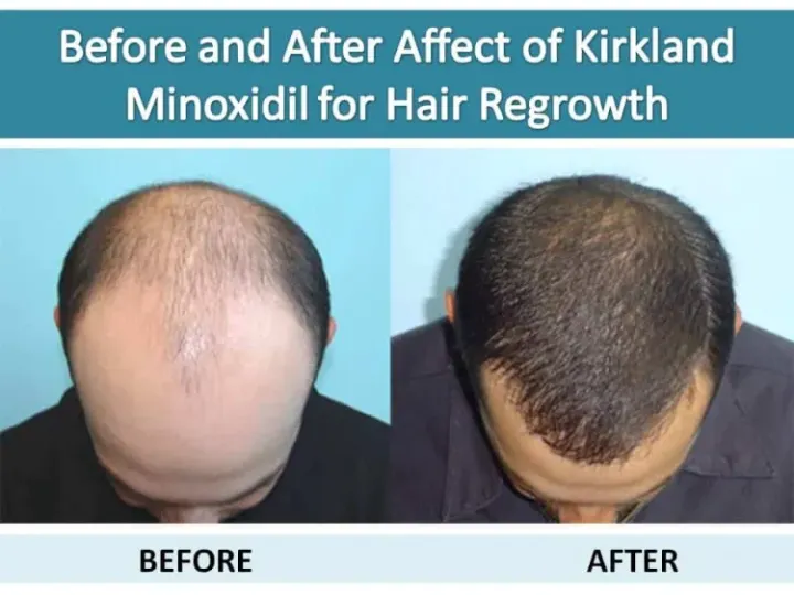 Imported%20Kirkland%20Minoxidil%205%25%20Hair%20Regrowth%20Solution%20for%20Men%20with%20Dropper%20Applicator%20-%201%20Month%20Supply%20%7C%20KIRKLAND%20MINOXIDIL%205%25%20USA%20HAIR%20&%20BEARD%20REGROWTH%20TREATMENT%20-%20Image%205