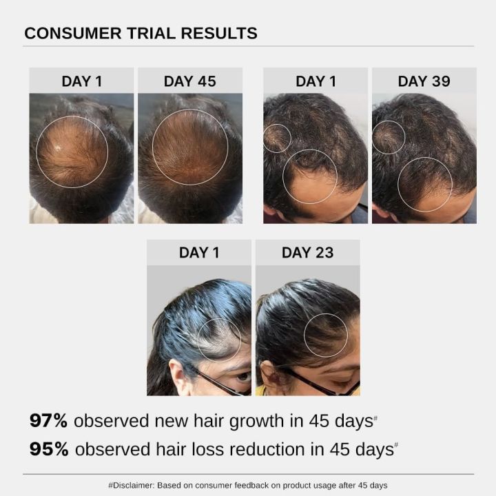 Bare%20Anatomy%20Advanced%20Hair%20Growth%20Serum%7C%203%25%20Redensyl%20-%202x%20Better%20Results%20than%20Minoxidil%20%7C%20+%204%25%20Anagain%20+%203%25%20Baicapil%20%7C%20Rosemary,%20Biotin%20%7C%20Hair%20growth%20&%20Hair%20fall%20control%20serum%20for%20Women%20&%20Men%20%7C%2030mL%20-%20Image%206