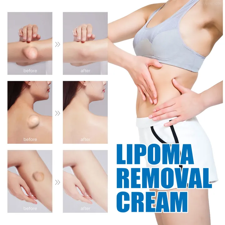 Lipoma%20Removal%20Cream%20Relief%20Pain%20Treat%20Skin%20Swelling%20Lipolysis%20Cellulite%20Fat%20Lump%20Nodule%20Removal%20Ointment%20Anti-tumor%20Plaster%20-%20Image%206