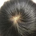 Human Hair Wig Toupee for Men with Hair Loss (most realistic scalp) 16*18. 