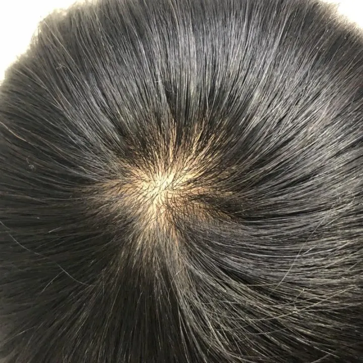 Human%20Hair%20Wig%20Toupee%20for%20Men%20with%20Hair%20Loss%20(most%20realistic%20scalp)%2016*18%20-%20Image%204