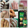 7 Day Nail Fungal Treatment Serum Foot Toe Nail Fungus Removal Essential Oil Infection Onychomycosis Paronychia Repair Gel. 