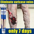Vitamin K Cream - Eliminate Spider Varicose Veins Scars Rosacea Capillaries6699885. 