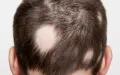 Ayurvedic Udugowwa Balm & Oil Pack – Effective Herbal Remedy for Hair Loss. 