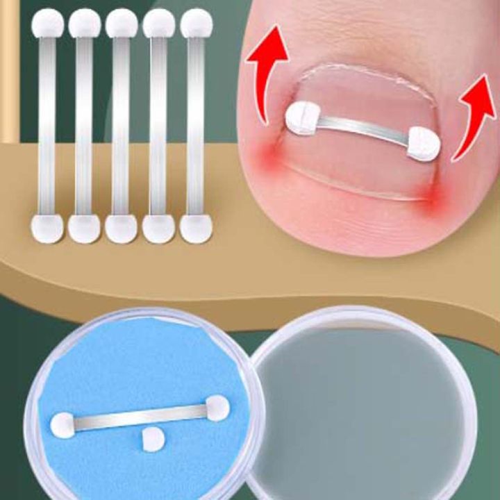 Splint For Ingrown Toenail65579371