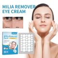 144pcs Milia Spot Patch Helps Dissolve Reduce Milia Hydrocolloid Acne Pimple Patch for Cover Zits/Pimples and Blemishes. 