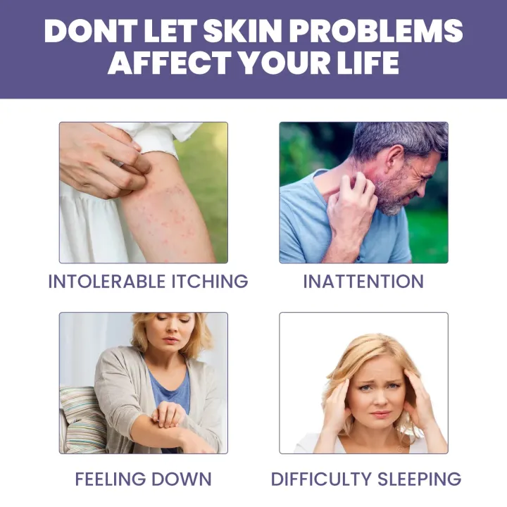 Eczema%20Treatment%20Cream%20Dermatitis%20Anti%20Itching%20Inhibit%20Fungi%20Urticaria%20Infection%20Prevent%20Hand%20Tinea%20Allergy%20Rash%20Repair%20Ointment%20-%20Image%204