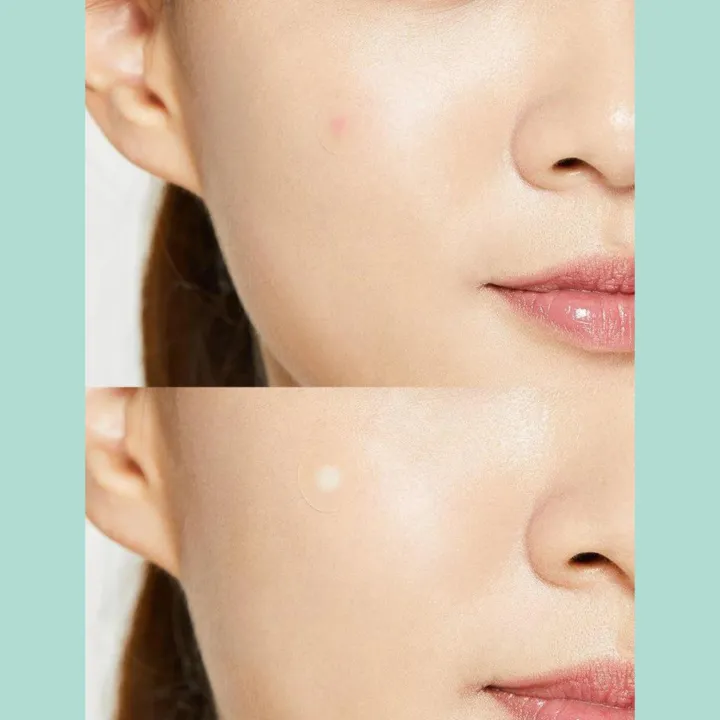 COSRX%20Acne%20Pimple%20Master%20Patch%20(24%20patches/1ea)%20-%20Image%204