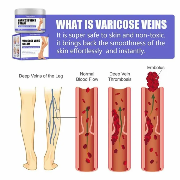 Varicose%20Vein%20Treatments%20Cream%20Effective%20Relieve%20Legs%20Dilated%20Vasculitis%20Phlebitis%20Natural%20Formula%20Ointment%20For%20Varicose%20Veins%20-%20Image%202