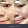Wenefang Fifty percent discount Chin Acne Pimple Patch Sticker Acne Treatment Pimple Remover Tool Blemish Spot Face Repair Patch Skin Care Waterproof 36 Patches. 