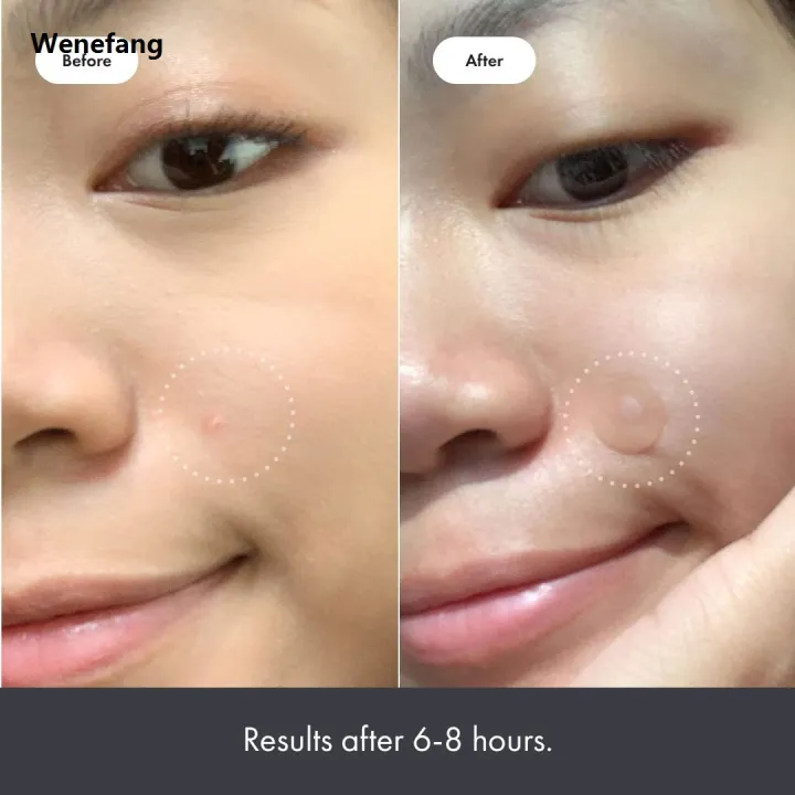 Wenefang%20Fifty%20percent%20discount%20Chin%20Acne%20Pimple%20Patch%20Sticker%20Acne%20Treatment%20Pimple%20Remover%20Tool%20Blemish%20Spot%20Face%20Repair%20Patch%20Skin%20Care%20Waterproof%2036%20Patches%20-%20Image%204