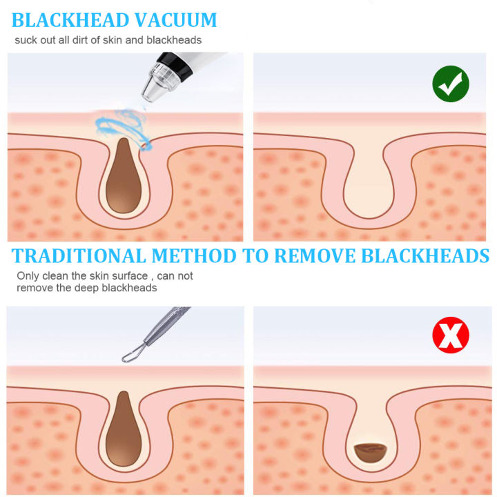 Weja%20Black%20Heads%20Remover%20Vacuum%20Facial%20Pore%20Vacuum%20Cleaner%20Electric%20USB%20Rechargeable%20-%20Image%206