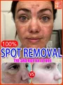 dark spot remover Melasma Chloasma black spots cream JinSong77. 