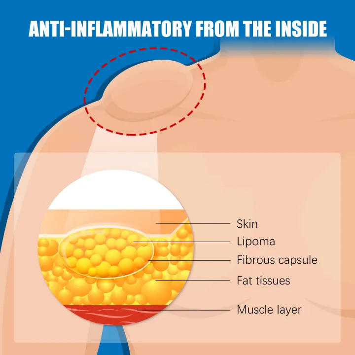 Lipoma%20Removal%20Cream%20Relief%20Pain%20Treat%20Skin%20Swelling%20Lipolysis%20Cellulite%20Fat%20Lump%20Nodule%20Removal%20Ointment%20Anti-tumor%20Plaster%20-%20Image%203