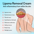 Lipoma Removal Cream Relief Pain Treat Skin Swelling Lipolysis Cellulite Fat Lump Nodule Removal Ointment Anti-tumor Plaster. 