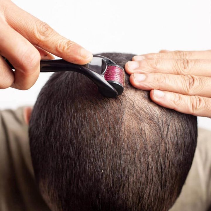 Derma%20Roller%200.5mm%20OriginaI%20Titanium%20540%20Micro%20Needle%20(TLS)%20-%20Image%202