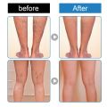 Spray for Varicose Veins Effective Varicose Vein Relief Cream To Relieve Leg Vasculitis Phlebitis Spider Pain Swelling Treatment. 