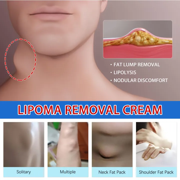 Lipoma%20Removal%20Cream%20Relief%20Pain%20Treat%20Skin%20Swelling%20Lipolysis%20Cellulite%20Fat%20Lump%20Nodule%20Removal%20Ointment%20Anti-tumor%20Plaster%20-%20Image%202