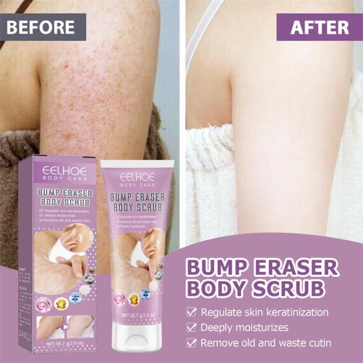 Repair Chicken Skin Body Scrub Keratosis Pilaris Lotion ffor Strawberry Legs Dark Spot Removal KP Bump Smooth Lotion Skin Care