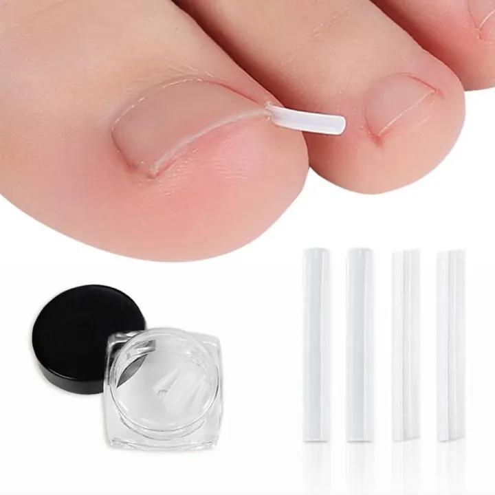 50Pcs/box%20New%20Brace%20Pedicure%20Tool%20Ingrown%20Toenail%20Correction%20Tool%20Filling%20Pad%20Nail%20Picker%20Elastic%20Patch%20Sticker%20Plastic%20Ingrown%20Toe%20Nail%20Treatment%20Straightening%20Clip%20-%20Image%203