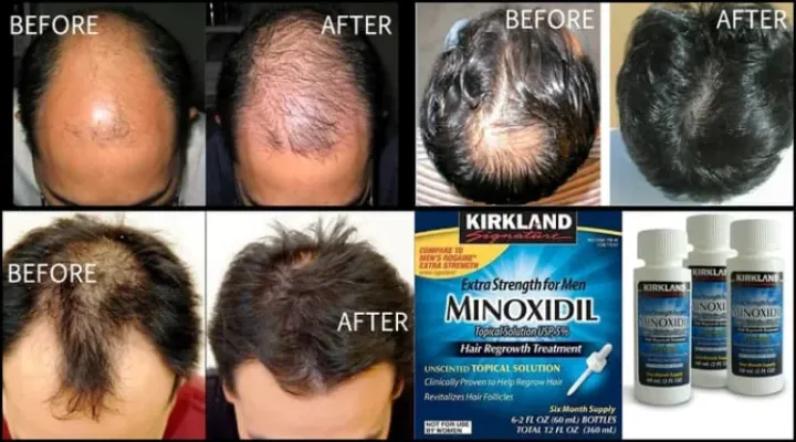 Imported%20Kirkland%20Minoxidil%205%25%20Hair%20Regrowth%20Solution%20for%20Men%20with%20Dropper%20Applicator%20-%201%20Month%20Supply%20%7C%20KIRKLAND%20MINOXIDIL%205%25%20USA%20HAIR%20&%20BEARD%20REGROWTH%20TREATMENT%20-%20Image%206