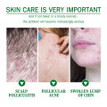 Folliculitis Antibacterial Cream Cysts Papules Spot Pustules Remover Scalp Follicles Blockage Itching Eczema Treatment Ointment. 