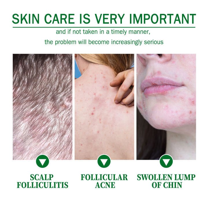 Folliculitis%20Antibacterial%20Cream%20Cysts%20Papules%20Spot%20Pustules%20Remover%20Scalp%20Follicles%20Blockage%20Itching%20Eczema%20Treatment%20Ointment%20-%20Image%203