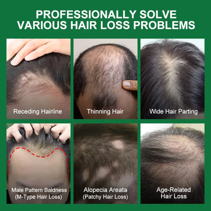 PURC%20Rosemary%20Oil%20Hair%20Growth%20Products%20for%20Man%20Women%20Ginger%20Anti%20Hair%20Loss%20Fast%20Regrowth%20Thicken%20Oils%20Scalp%20Treatment%20Hair%20Care%20-%20Image%207