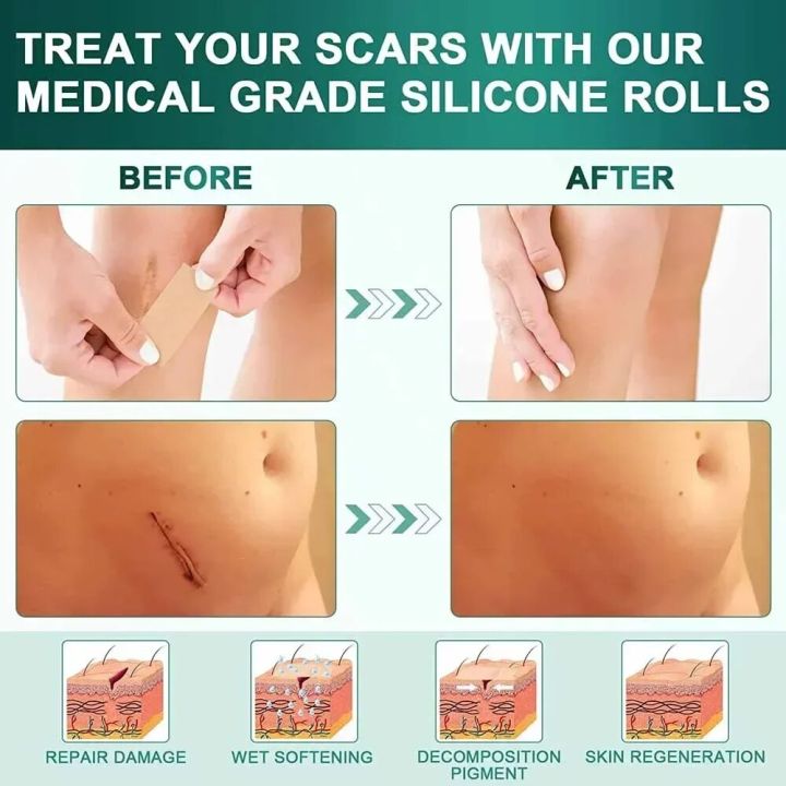 1%20Roll%20Reusable%20Scars%20Removal%20Sheets,Silicone%20Scars%20Sheets%20Tape%20for%20Surgical%20Scars,Healing%20Keloid,C-Section,Tummy%20Tuck,Burn,Acne%20-%20Image%202