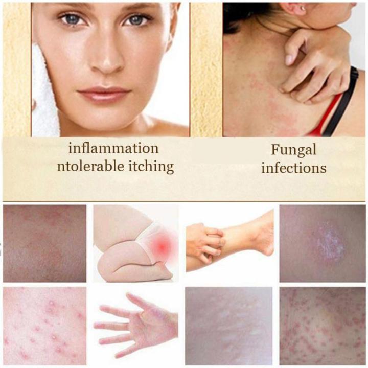 Diseases%20Of%20Sulfur%20Toiletries%20Seborrheic%20Skin%20Household%20Eczema%20Acne%20Dermatitis%20Psoriasis%20Anti-Fungal%20Treatment%20Soap(1Pcs)%20-%20Image%205