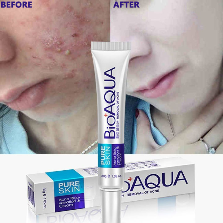 Bioaqua%20Mark%20Removal%20Gel%20Ointment%20Pure%20Anti%20Acne%20Cream%2030G%20-%20Image%205