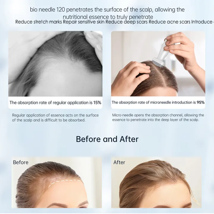 Authentic%20120Pins%20Reusable%20Derma%20Stamp%20For%20Hair%20Growth%20Adjustable%20Length%200-2mm%20Microneedling%20Face%20Skincare%20-%20Image%208
