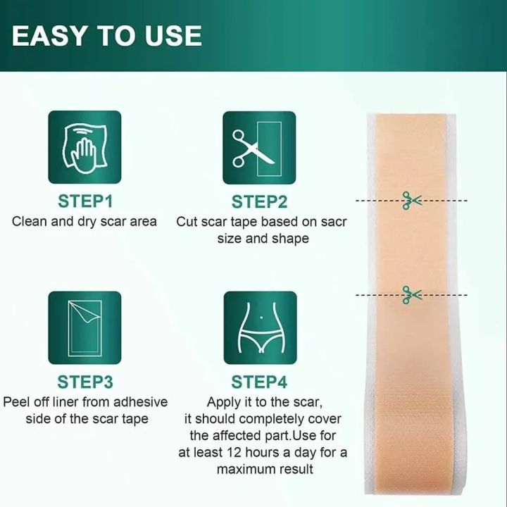 1%20Roll%20Reusable%20Scars%20Removal%20Sheets,Silicone%20Scars%20Sheets%20Tape%20for%20Surgical%20Scars,Healing%20Keloid,C-Section,Tummy%20Tuck,Burn,Acne%20-%20Image%205