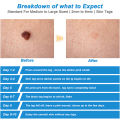 2 IN 1 Auto Micro Skin Tag Remover Device Standard And Micro Skin Tag Removal Kit Adult Mole Wart Remover Face Care Beauty Tools. 