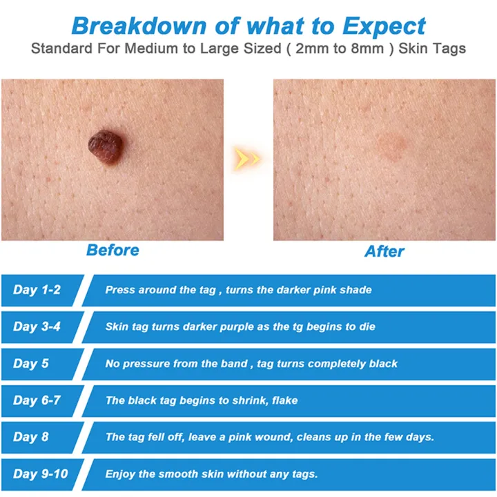 2%20IN%201%20Auto%20Micro%20Skin%20Tag%20Remover%20Device%20Standard%20And%20Micro%20Skin%20Tag%20Removal%20Kit%20Adult%20Mole%20Wart%20Remover%20Face%20Care%20Beauty%20Tools%20-%20Image%205