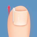 50Pcs/box New Brace Pedicure Tool Ingrown Toenail Correction Tool Filling Pad Nail Picker Elastic Patch Sticker Plastic Ingrown Toe Nail Treatment Straightening Clip. 