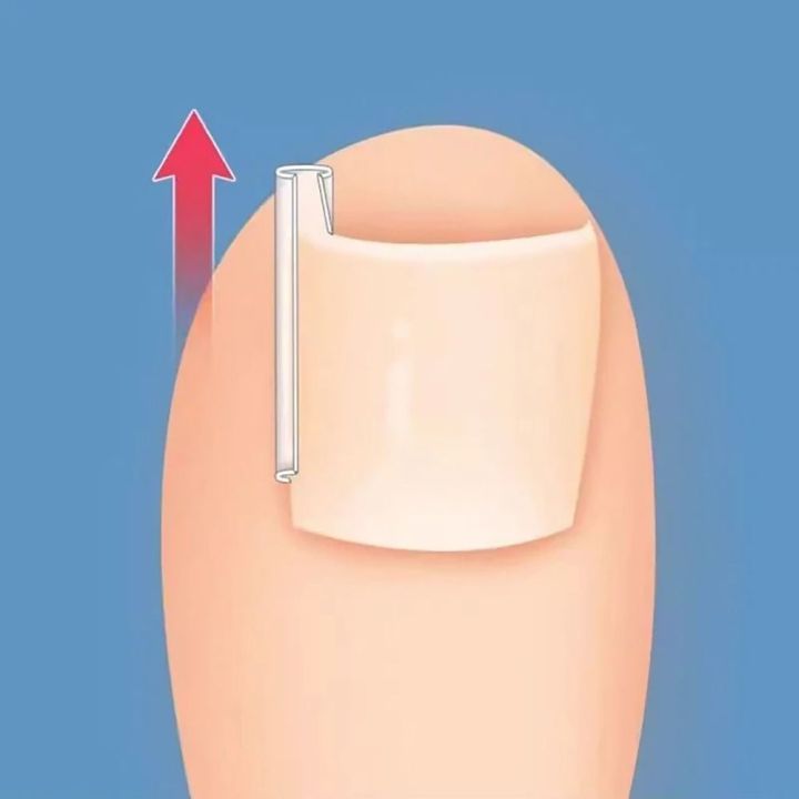 50Pcs/box%20New%20Brace%20Pedicure%20Tool%20Ingrown%20Toenail%20Correction%20Tool%20Filling%20Pad%20Nail%20Picker%20Elastic%20Patch%20Sticker%20Plastic%20Ingrown%20Toe%20Nail%20Treatment%20Straightening%20Clip%20-%20Image%204