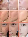dark spot remover Melasma Chloasma black spots cream JinSong77. 